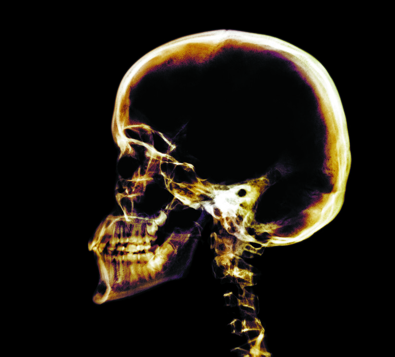 X-ray of a human skull