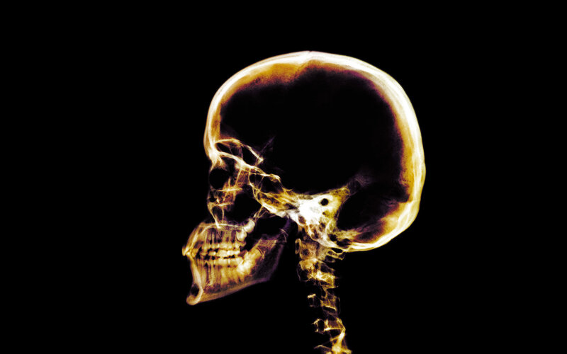 X-ray of a human skull