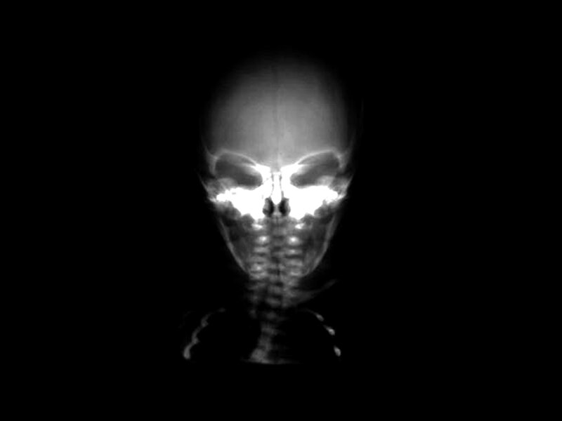 X-ray of a skull