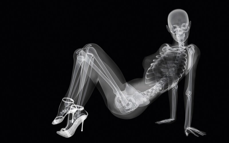 X-ray of a woman in high heels