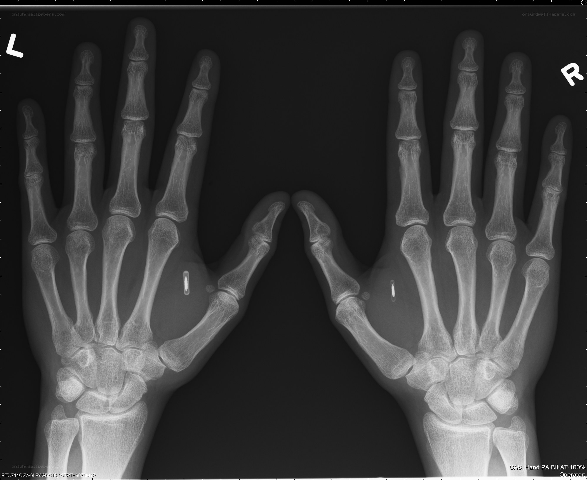 X-ray of both hands