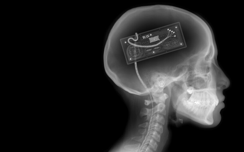 X-ray of brain implant
