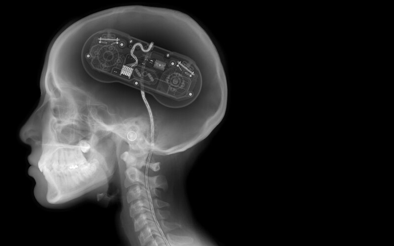X-ray of brain implant