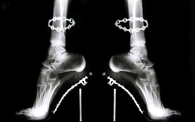 X-ray of Feet with Implants