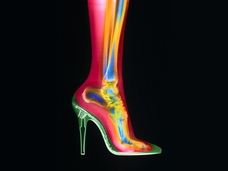 X-ray of foot in high heel