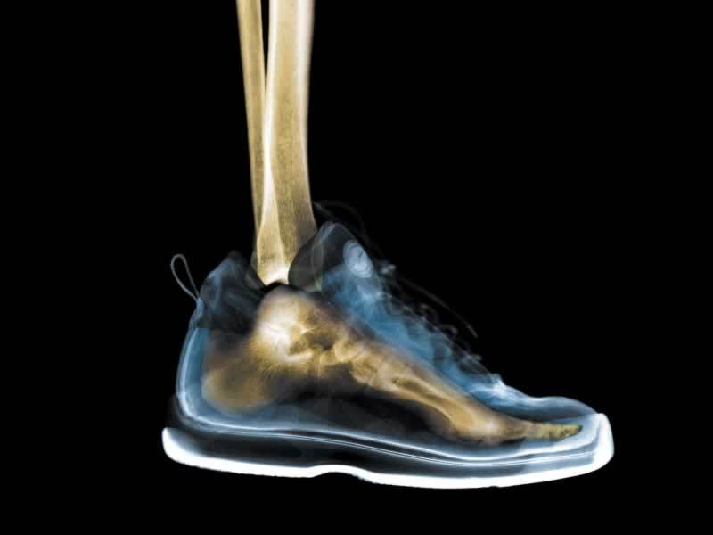 X-ray of foot in sneaker