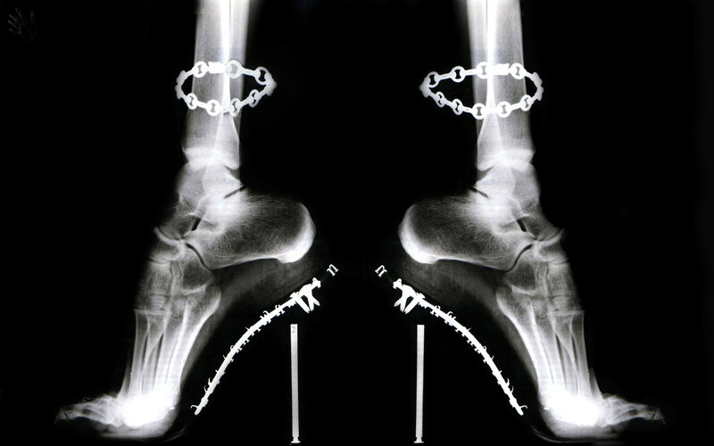 X-ray of foot surgery