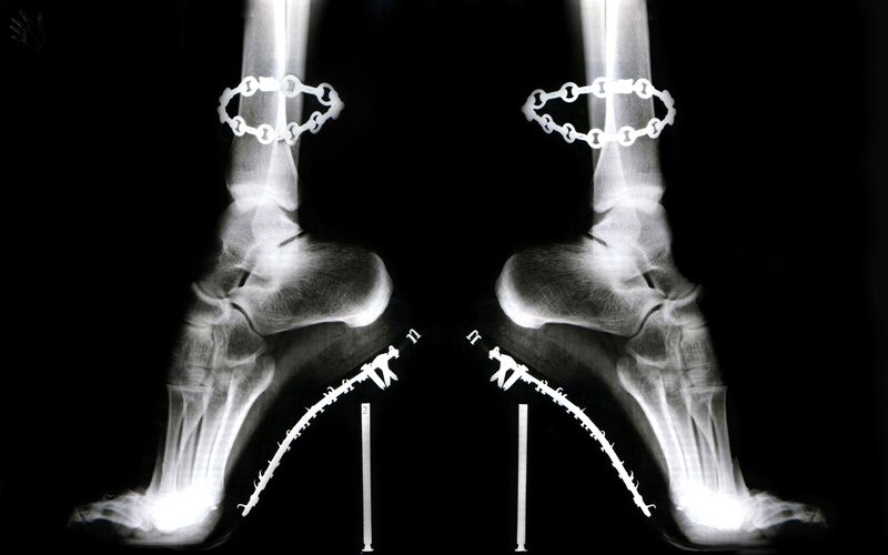 X-ray of foot with surgical hardware