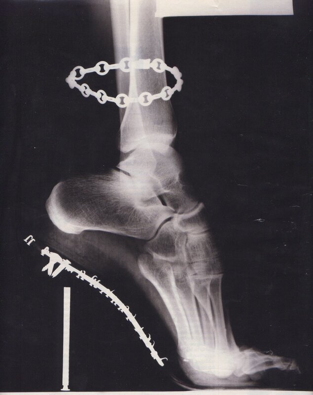 X-ray of foot with surgical hardware