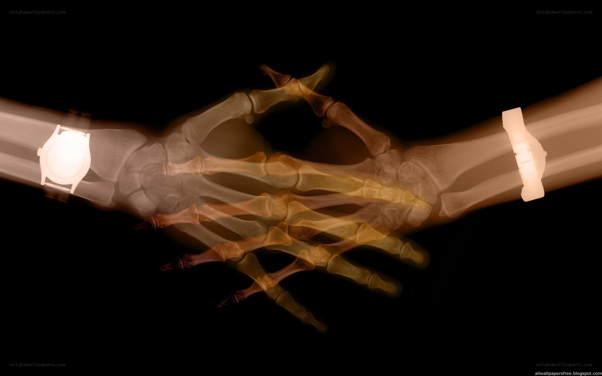 X-ray of hands shaking