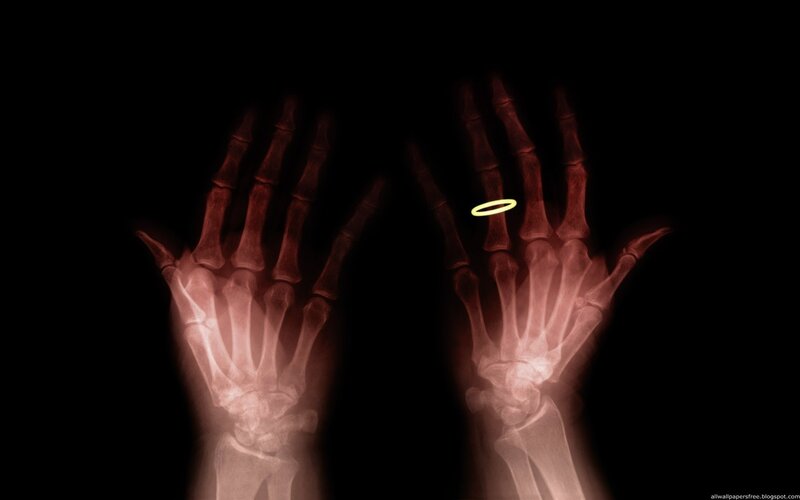 X-ray of hands with ring