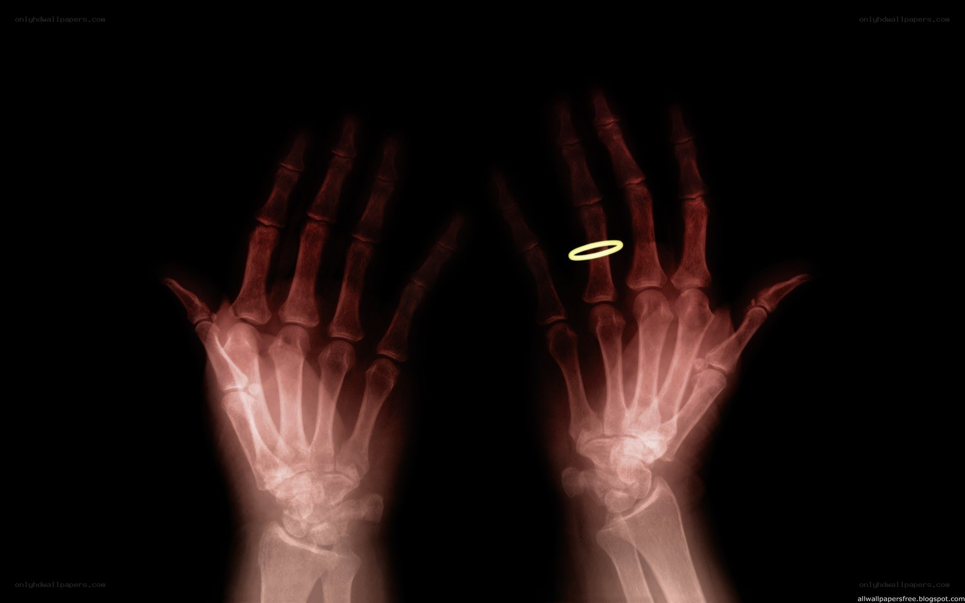 X-ray of hands with ring