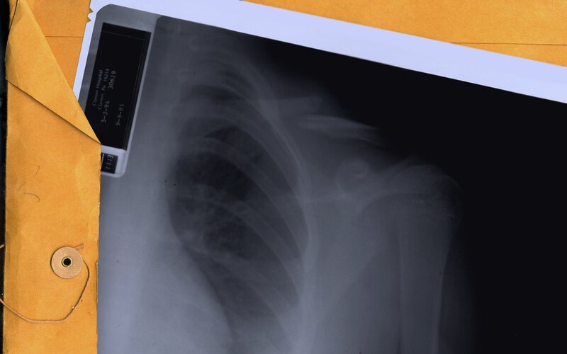 X-ray of shoulder and chest