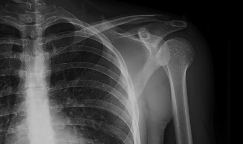 X-ray of shoulder and rib cage
