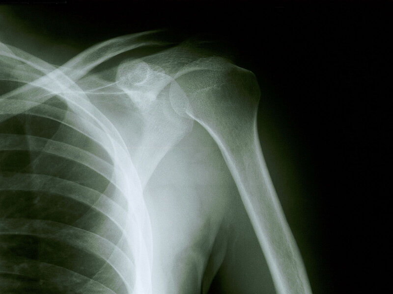 X-ray of Shoulder Joint