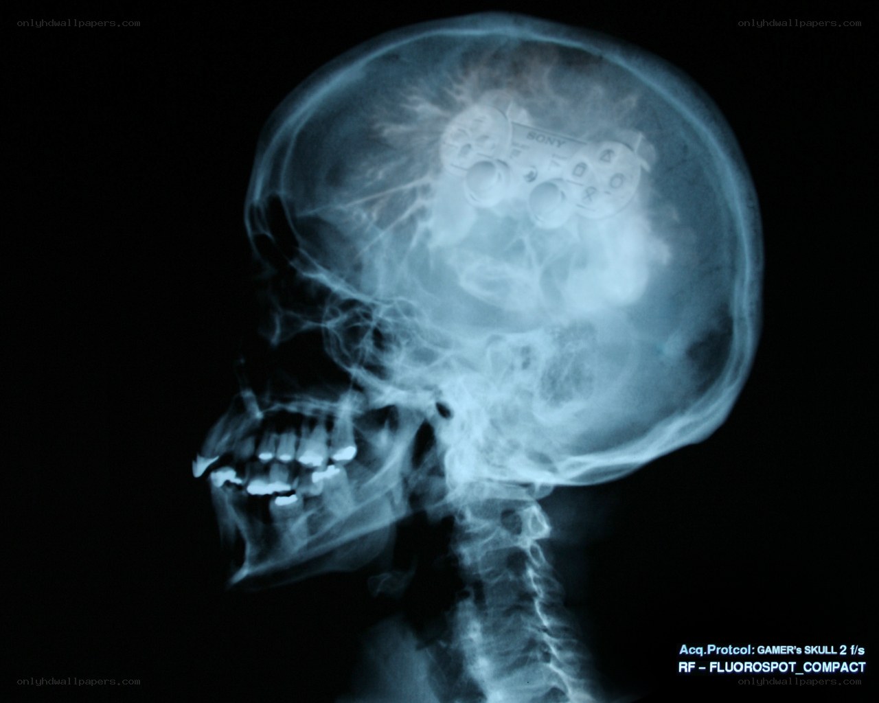 X-ray of skull with game controller