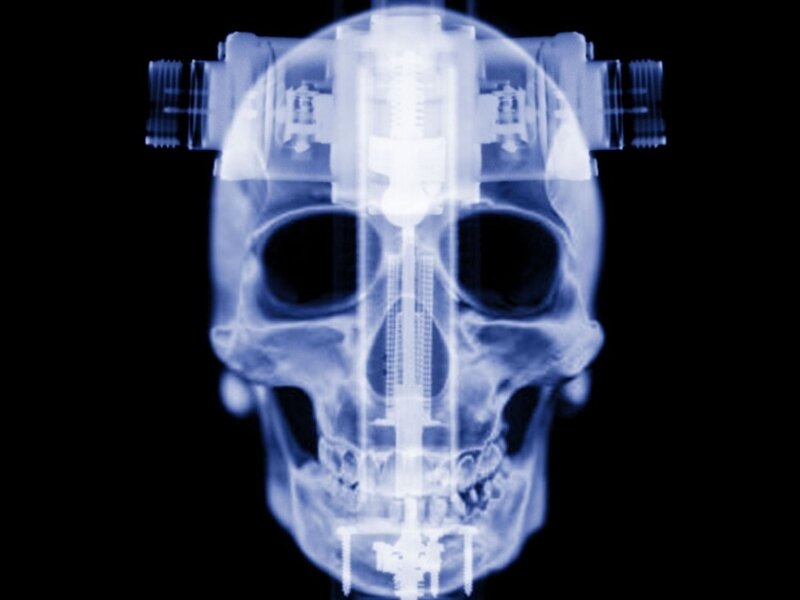 X-ray of skull with medical device