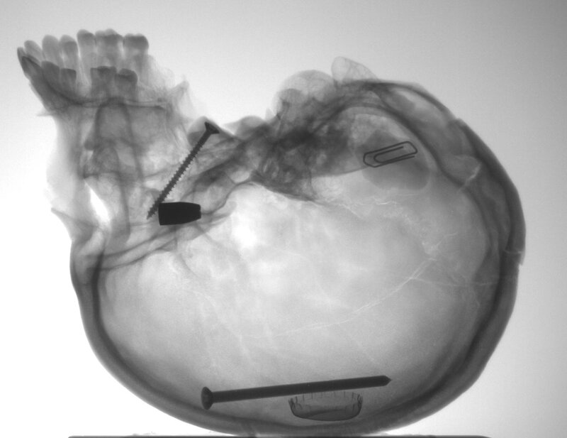 X-ray of skull with surgical hardware