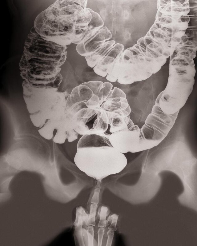 X-ray of the colon