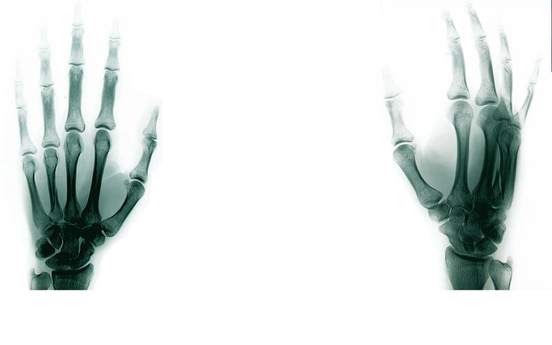 X-ray of two hands