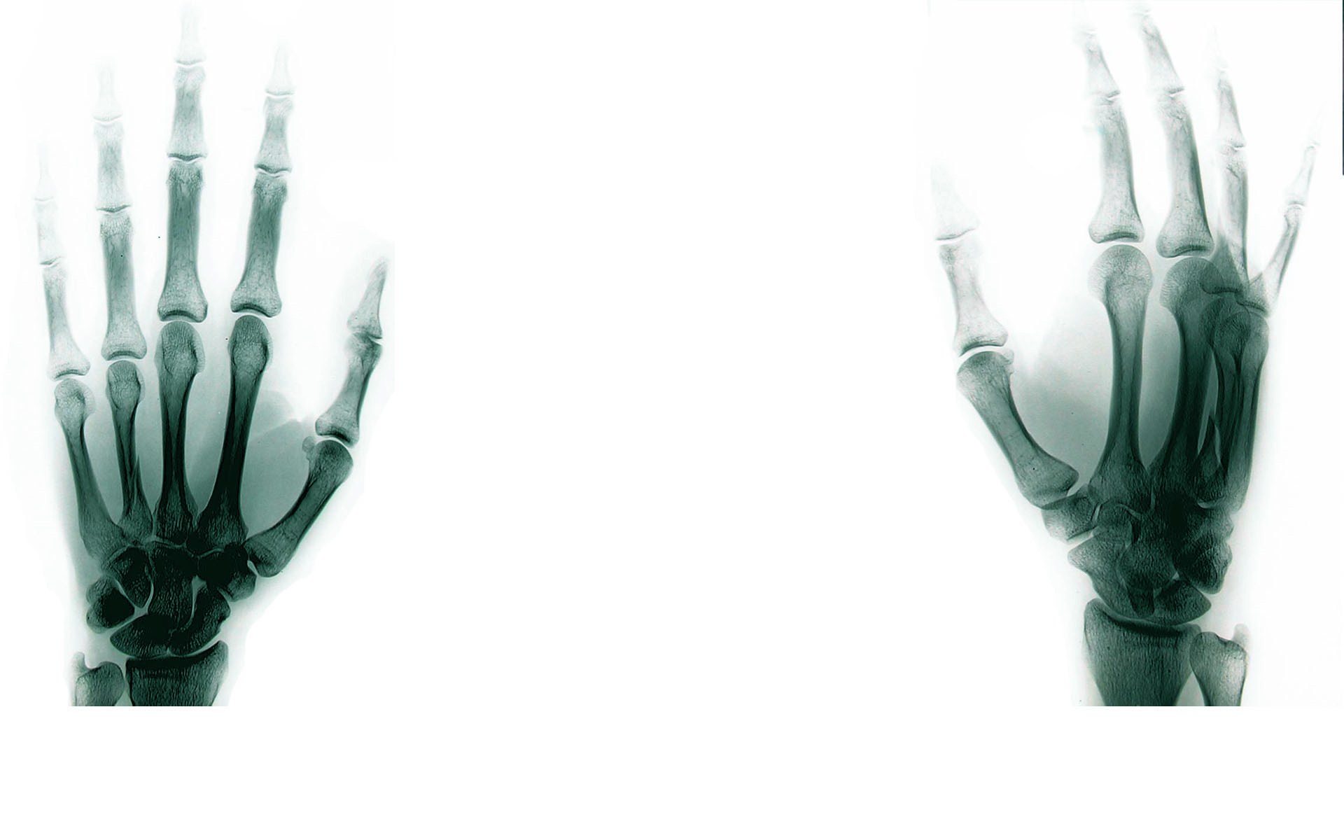 X-ray of two hands