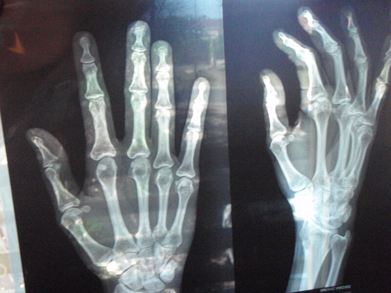 X-ray of Two Hands — Black