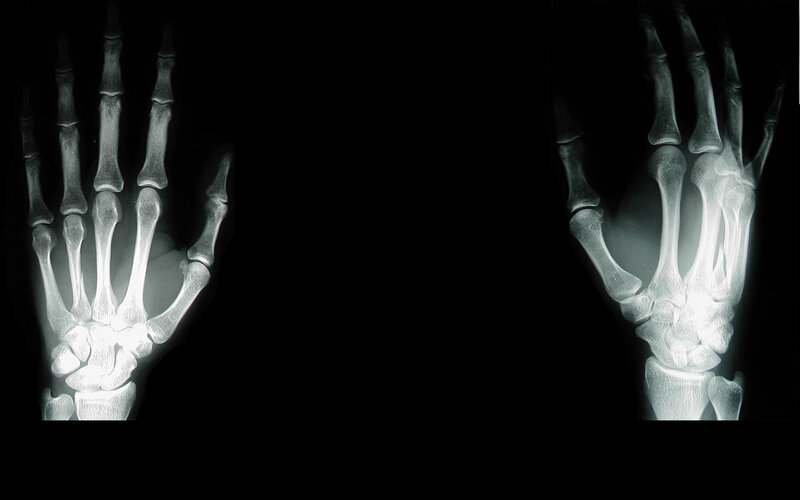 X-ray of two hands
