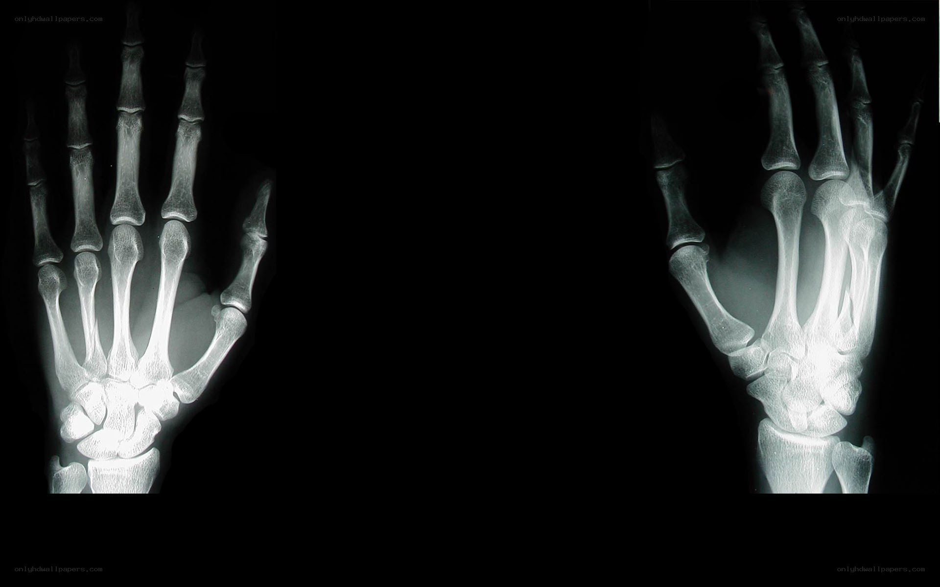 X-ray of two hands