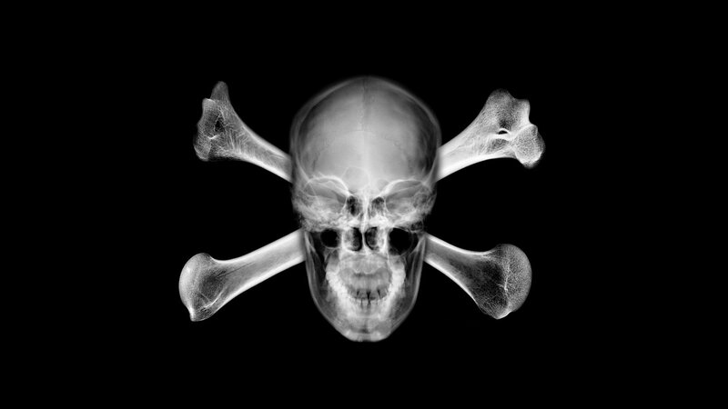 X-ray skull and bones