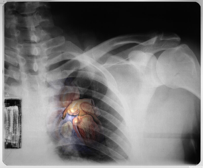 X-ray with heart overlay